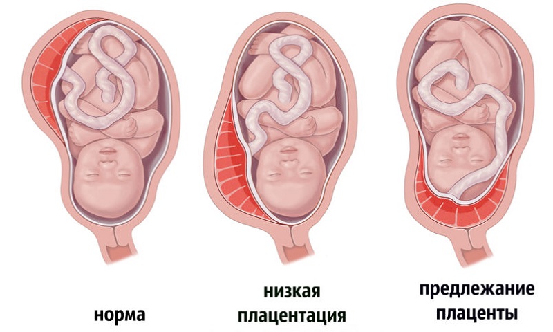 Упражнения для поднятия плаценты при беременности